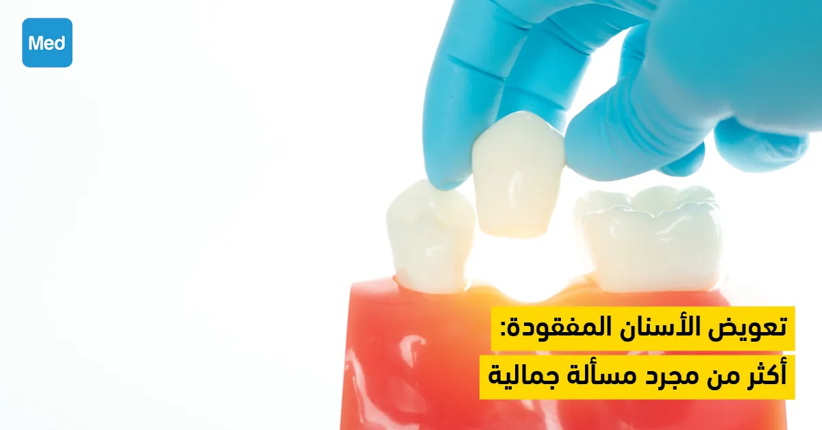 تعويض الأسنان المفقودة : أكثر من مجرد مسألة جمالية